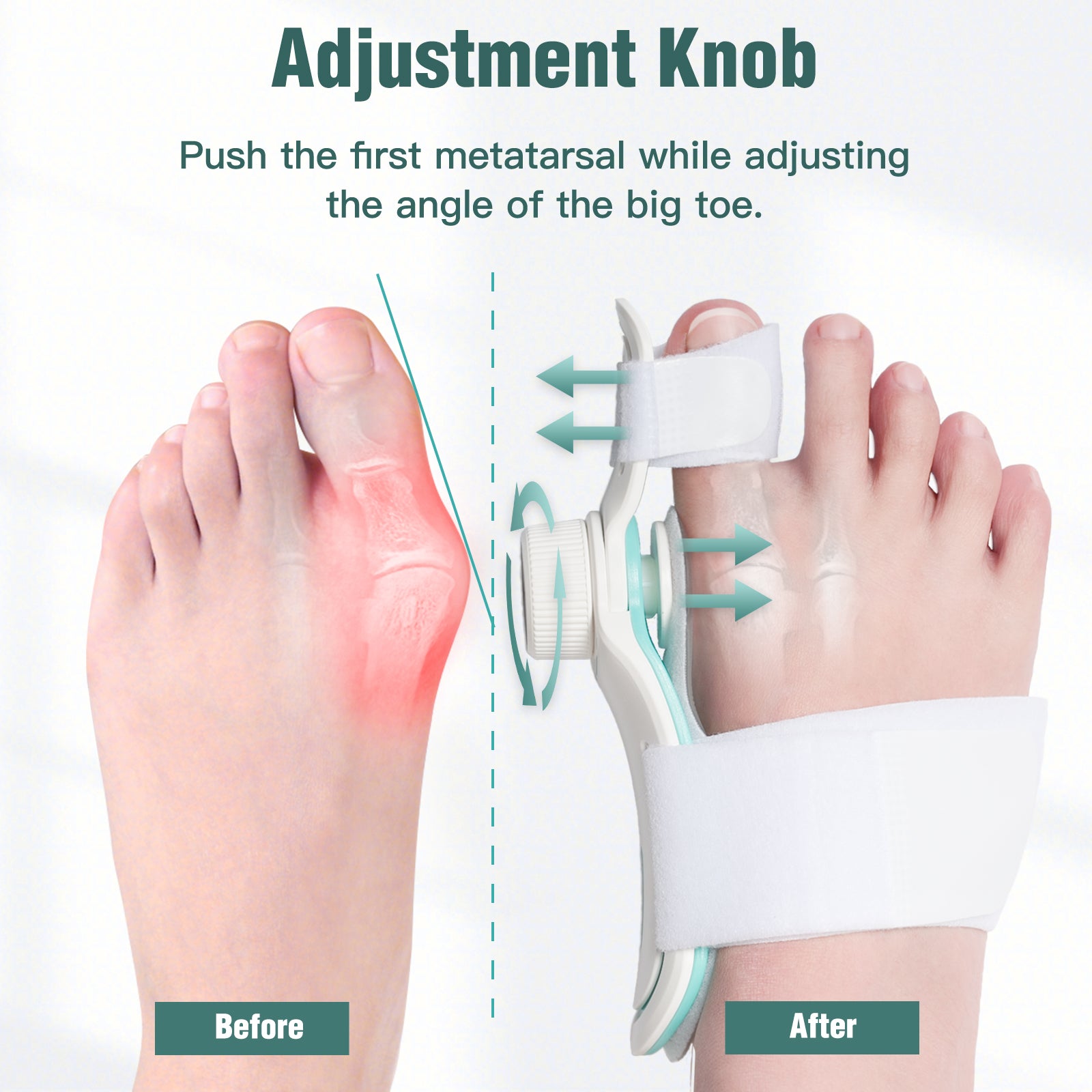 Bunion Corrector - Presale (Expect to Ship by 20th May)