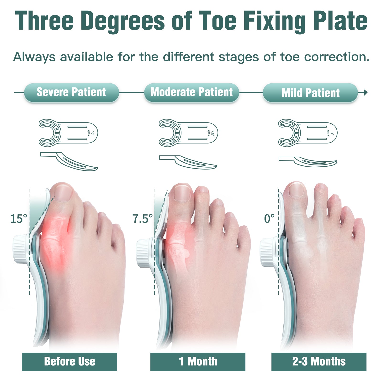 Bunion Corrector - Presale (Expect to Ship by 20th May)